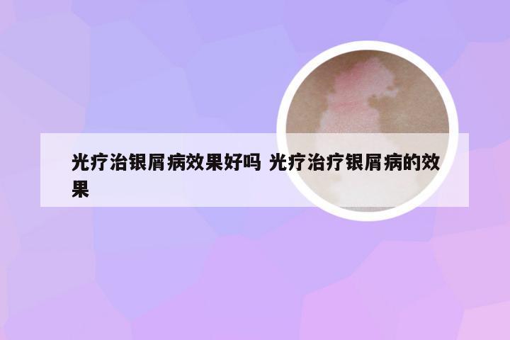 光疗治银屑病效果好吗 光疗治疗银屑病的效果