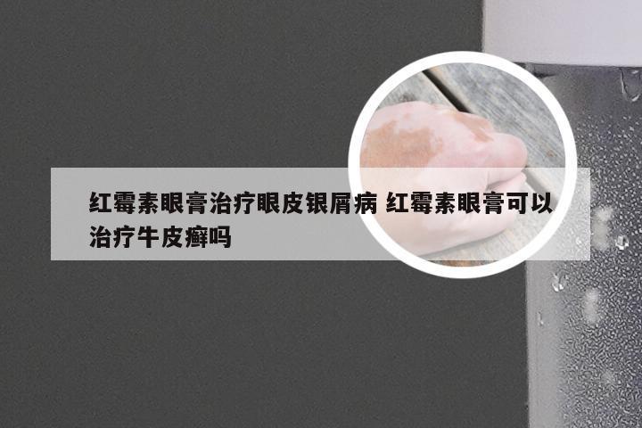 红霉素眼膏治疗眼皮银屑病 红霉素眼膏可以治疗牛皮癣吗