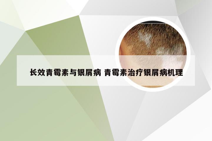 长效青霉素与银屑病 青霉素治疗银屑病机理