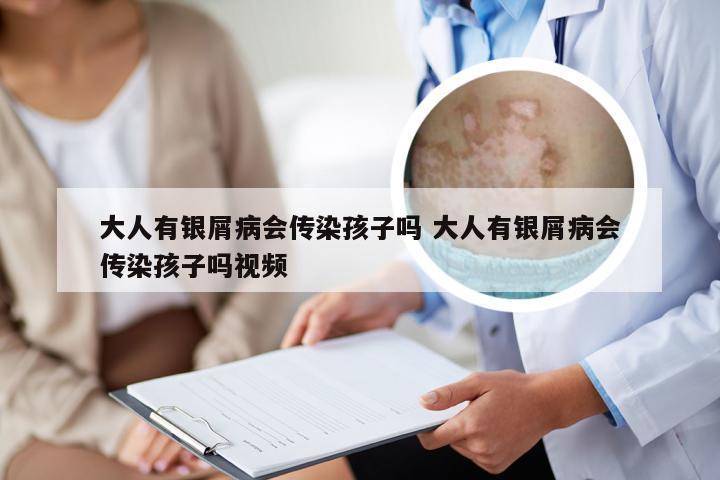 大人有银屑病会传染孩子吗 大人有银屑病会传染孩子吗视频