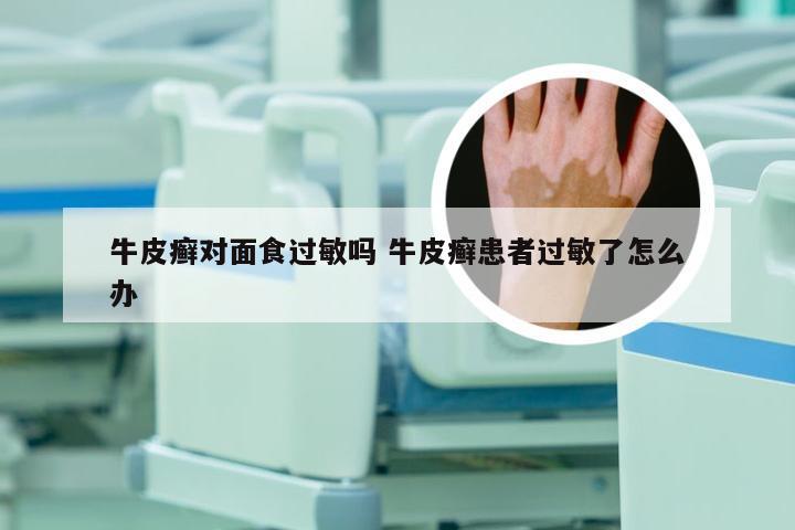 牛皮癣对面食过敏吗 牛皮癣患者过敏了怎么办