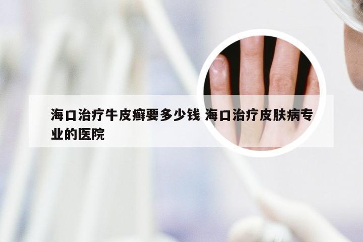 海口治疗牛皮癣要多少钱 海口治疗皮肤病专业的医院
