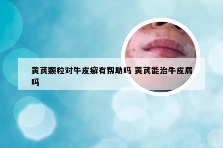 黄芪颗粒对牛皮癣有帮助吗 黄芪能治牛皮屑吗