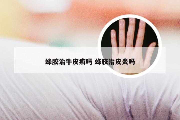 蜂胶治牛皮癣吗 蜂胶治皮炎吗