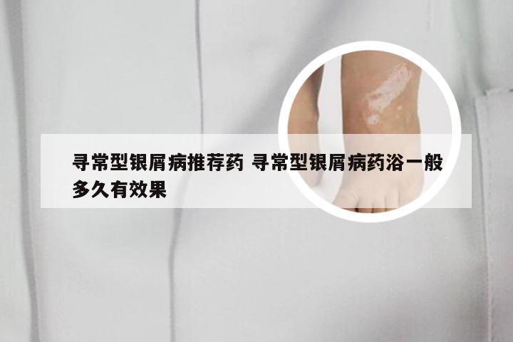 寻常型银屑病推荐药 寻常型银屑病药浴一般多久有效果