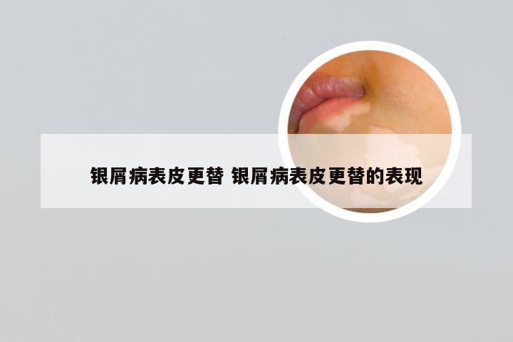 银屑病表皮更替 银屑病表皮更替的表现