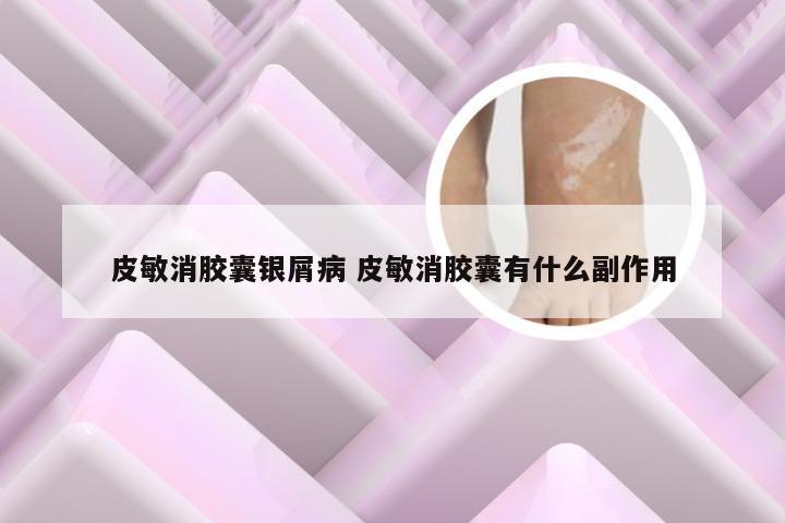 皮敏消胶囊银屑病 皮敏消胶囊有什么副作用