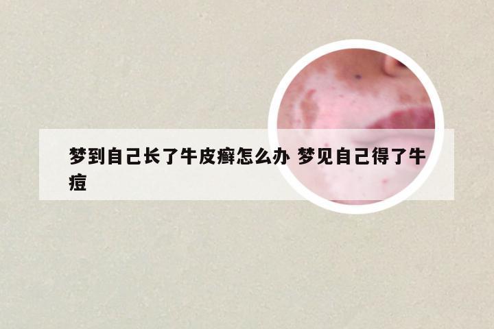 梦到自己长了牛皮癣怎么办 梦见自己得了牛痘