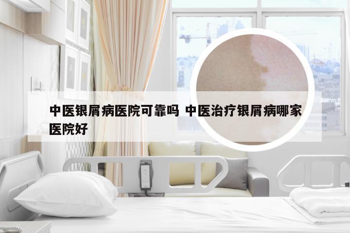 中医银屑病医院可靠吗 中医治疗银屑病哪家医院好