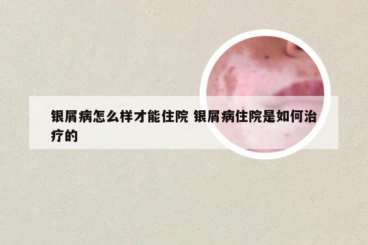 银屑病怎么样才能住院 银屑病住院是如何治疗的