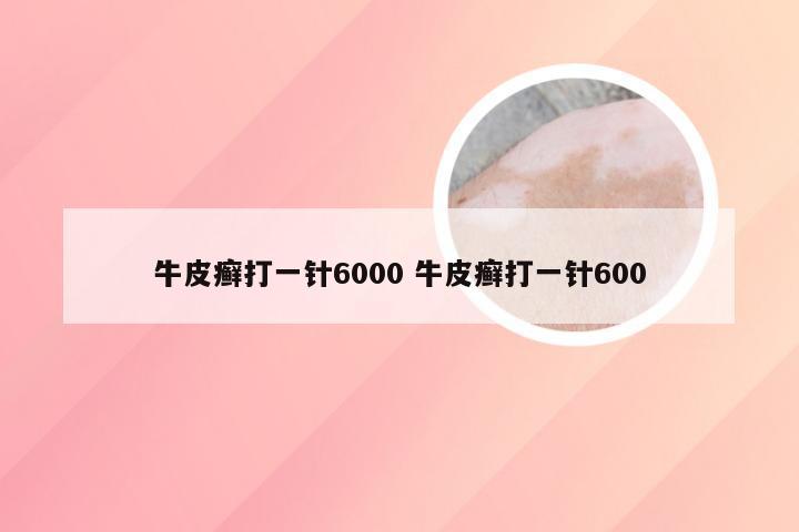 牛皮癣打一针6000 牛皮癣打一针600