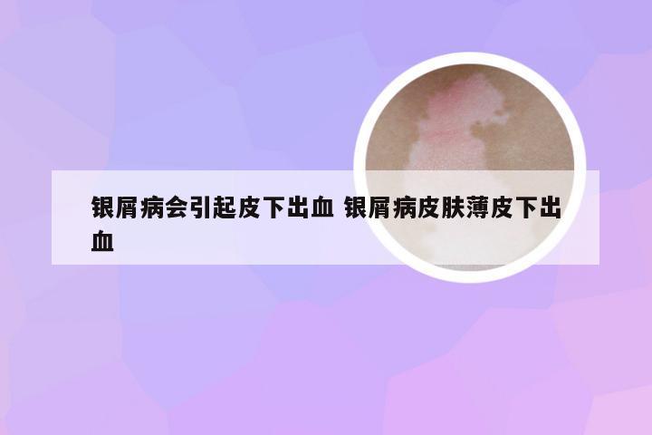银屑病会引起皮下出血 银屑病皮肤薄皮下出血