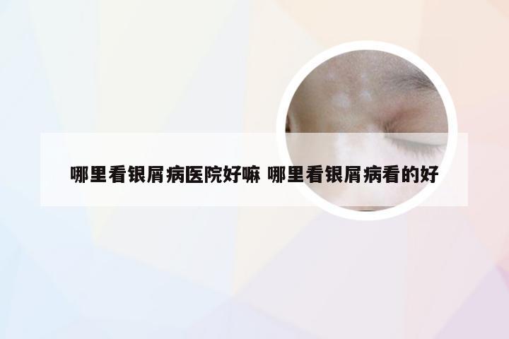 哪里看银屑病医院好嘛 哪里看银屑病看的好