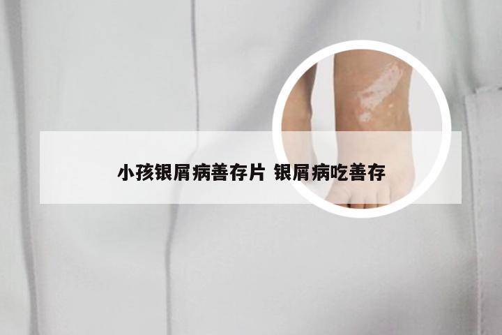 小孩银屑病善存片 银屑病吃善存