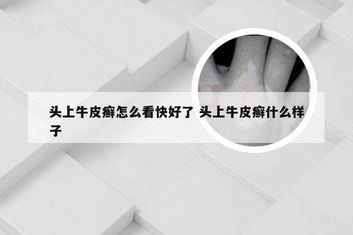 头上牛皮癣怎么看快好了 头上牛皮癣什么样子