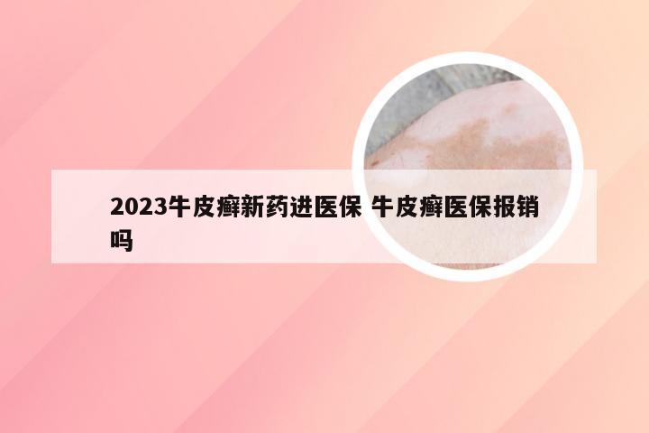 2023牛皮癣新药进医保 牛皮癣医保报销吗