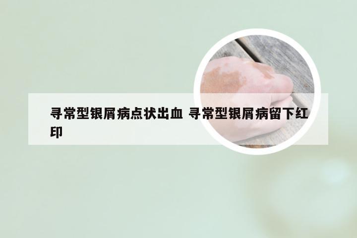 寻常型银屑病点状出血 寻常型银屑病留下红印