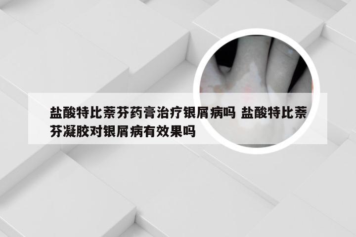 盐酸特比萘芬药膏治疗银屑病吗 盐酸特比萘芬凝胶对银屑病有效果吗