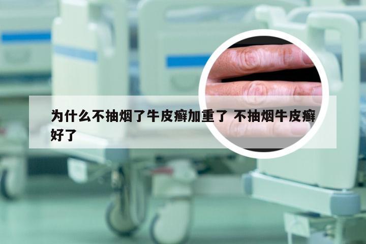 为什么不抽烟了牛皮癣加重了 不抽烟牛皮癣好了