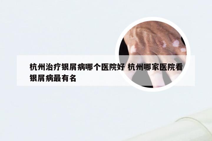 杭州治疗银屑病哪个医院好 杭州哪家医院看银屑病最有名