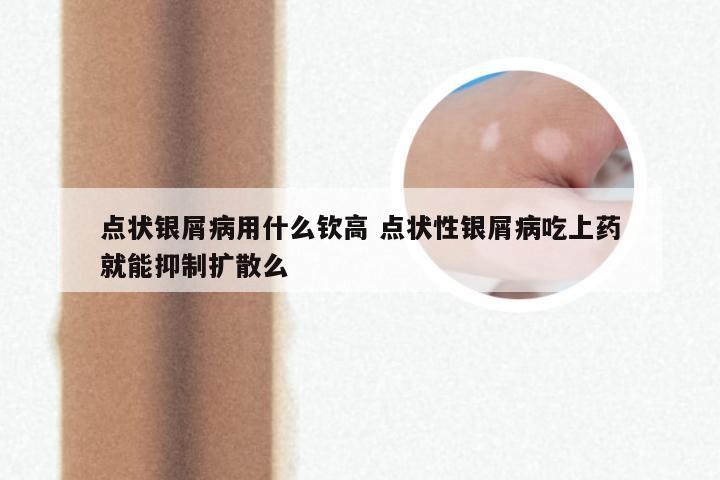 点状银屑病用什么钦高 点状性银屑病吃上药就能抑制扩散么