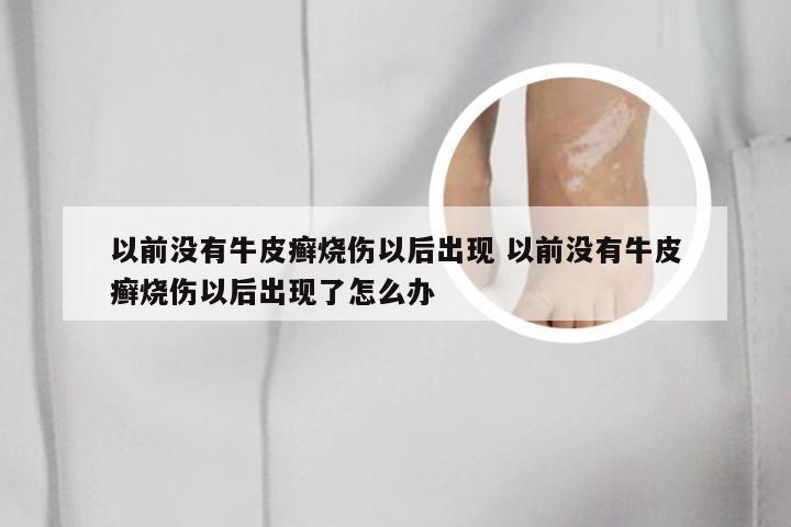 以前没有牛皮癣烧伤以后出现 以前没有牛皮癣烧伤以后出现了怎么办