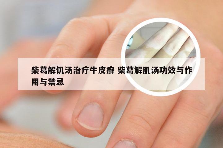 柴葛解饥汤治疗牛皮癣 柴葛解肌汤功效与作用与禁忌