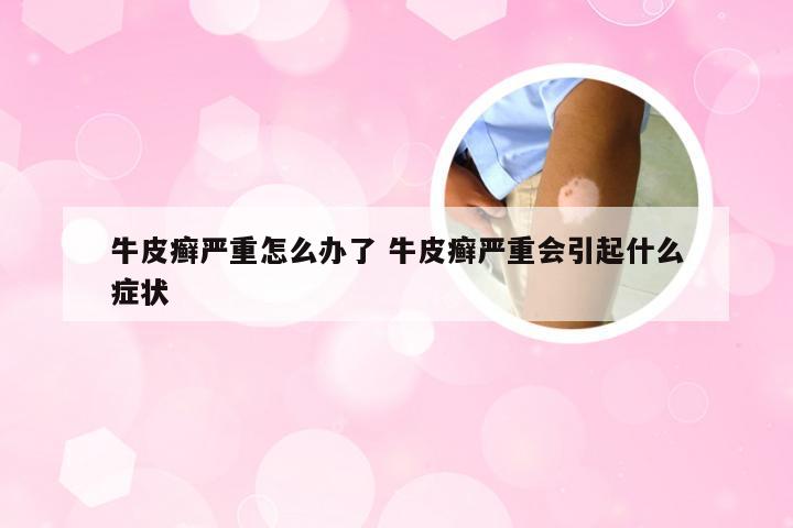 牛皮癣严重怎么办了 牛皮癣严重会引起什么症状