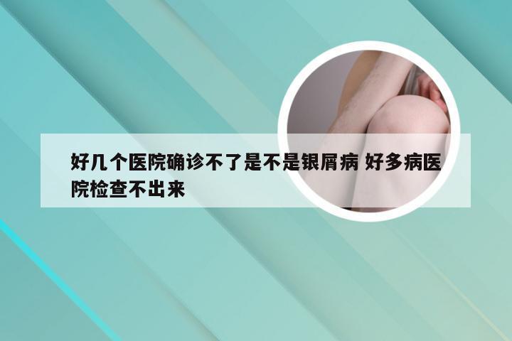 好几个医院确诊不了是不是银屑病 好多病医院检查不出来