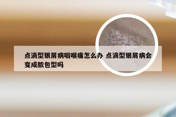 点滴型银屑病咽喉痛怎么办 点滴型银屑病会变成脓包型吗