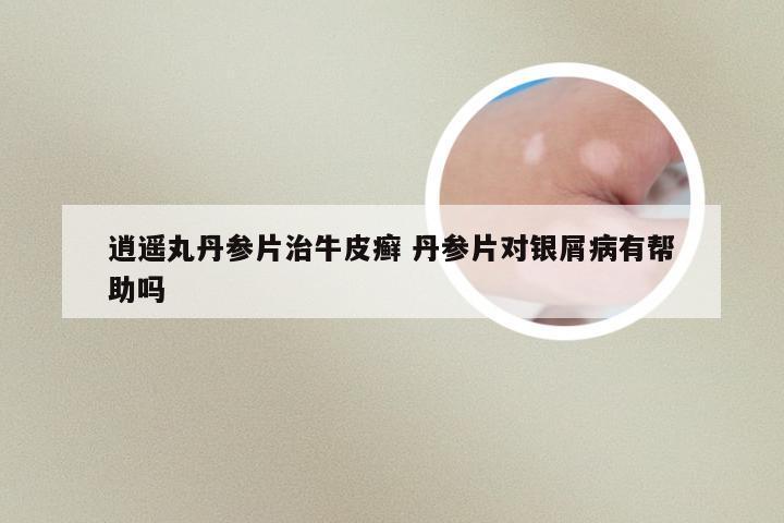 逍遥丸丹参片治牛皮癣 丹参片对银屑病有帮助吗