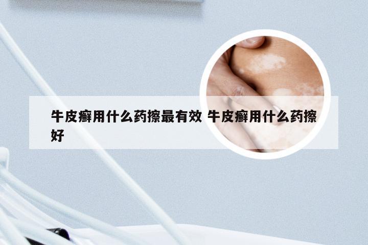 牛皮癣用什么药擦最有效 牛皮癣用什么药擦好