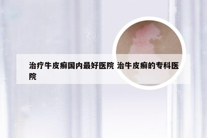 治疗牛皮癣国内最好医院 治牛皮癣的专科医院