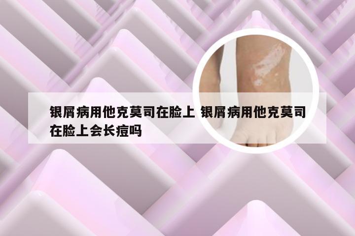 银屑病用他克莫司在脸上 银屑病用他克莫司在脸上会长痘吗