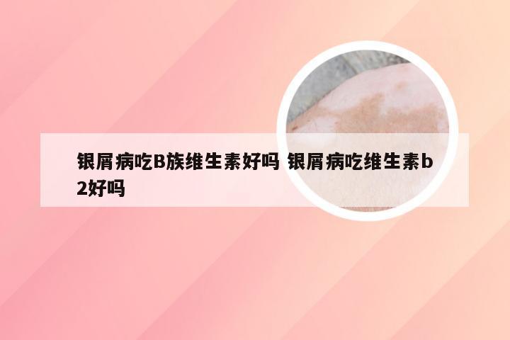 银屑病吃B族维生素好吗 银屑病吃维生素b2好吗