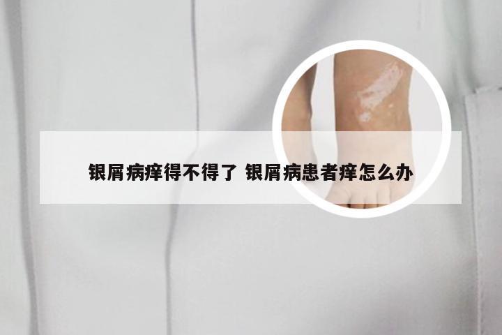银屑病痒得不得了 银屑病患者痒怎么办