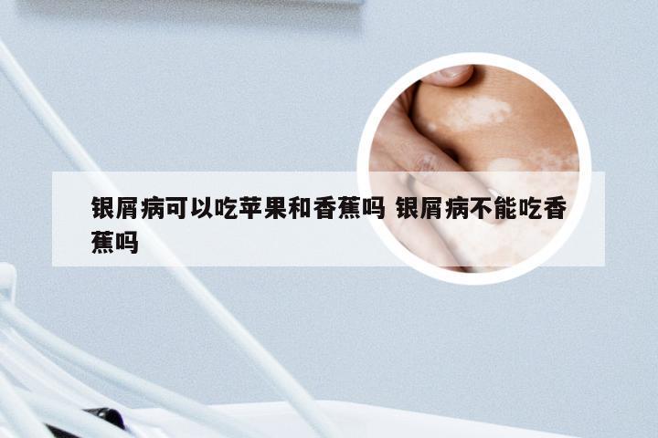 银屑病可以吃苹果和香蕉吗 银屑病不能吃香蕉吗