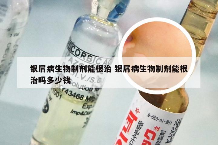 银屑病生物制剂能根治 银屑病生物制剂能根治吗多少钱