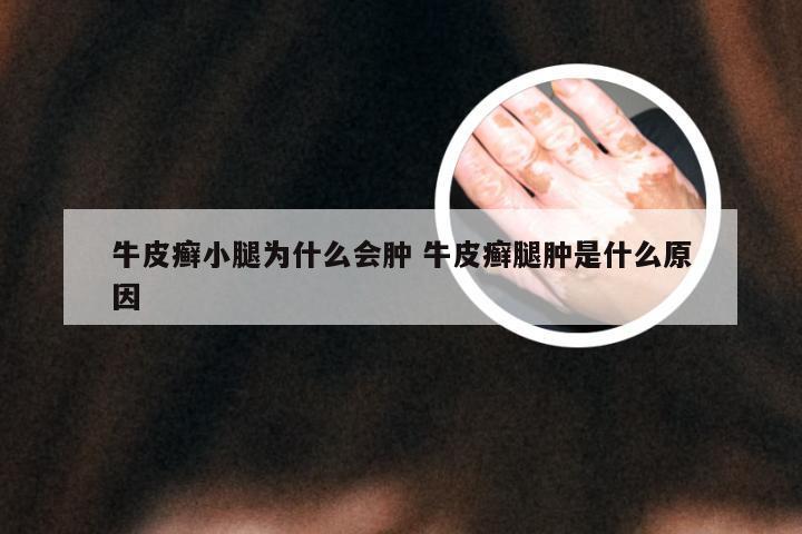 牛皮癣小腿为什么会肿 牛皮癣腿肿是什么原因