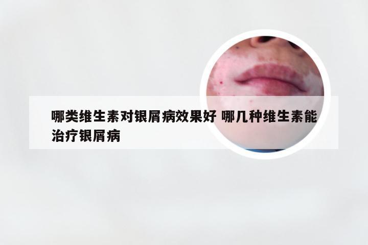 哪类维生素对银屑病效果好 哪几种维生素能治疗银屑病