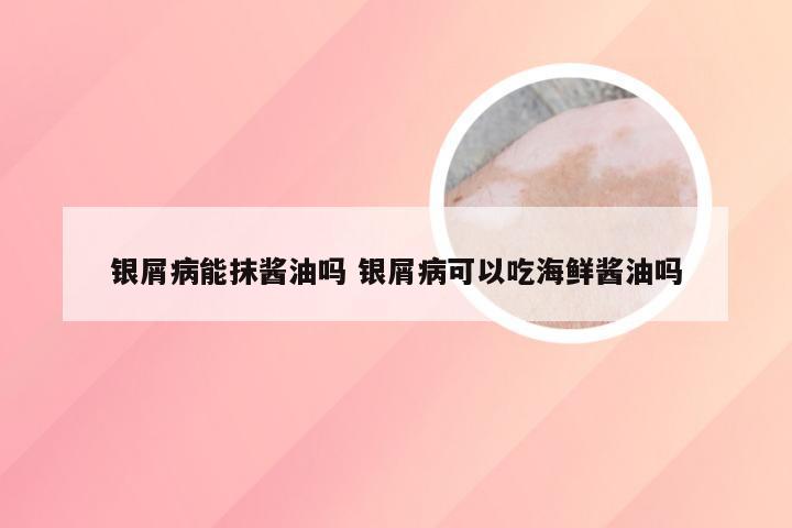 银屑病能抹酱油吗 银屑病可以吃海鲜酱油吗