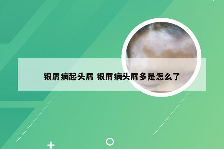 银屑病起头屑 银屑病头屑多是怎么了