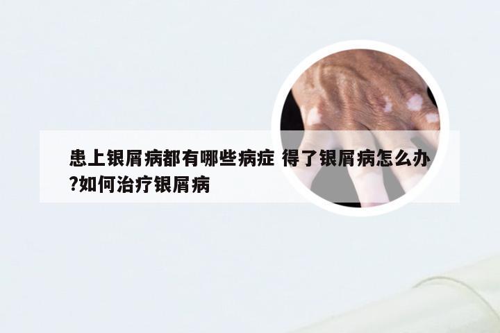 患上银屑病都有哪些病症 得了银屑病怎么办?如何治疗银屑病