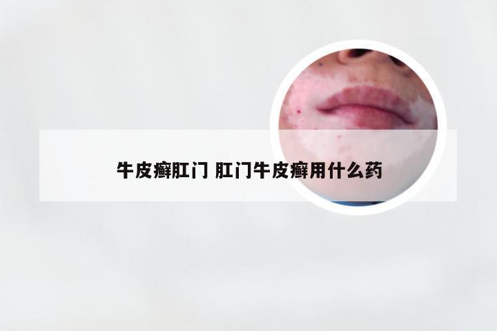 牛皮癣肛门 肛门牛皮癣用什么药