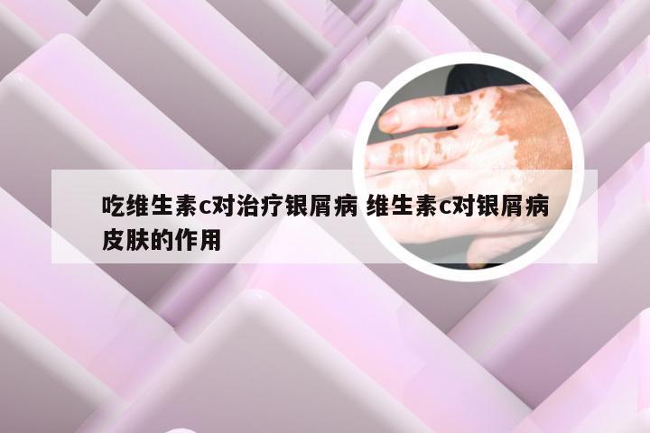 吃维生素c对治疗银屑病 维生素c对银屑病皮肤的作用