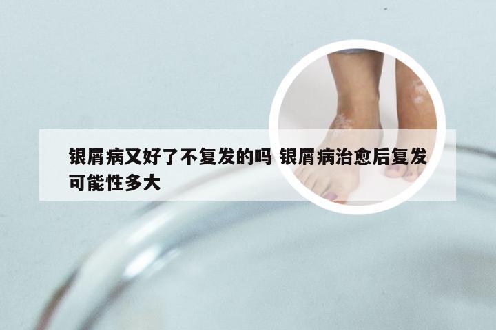 银屑病又好了不复发的吗 银屑病治愈后复发可能性多大