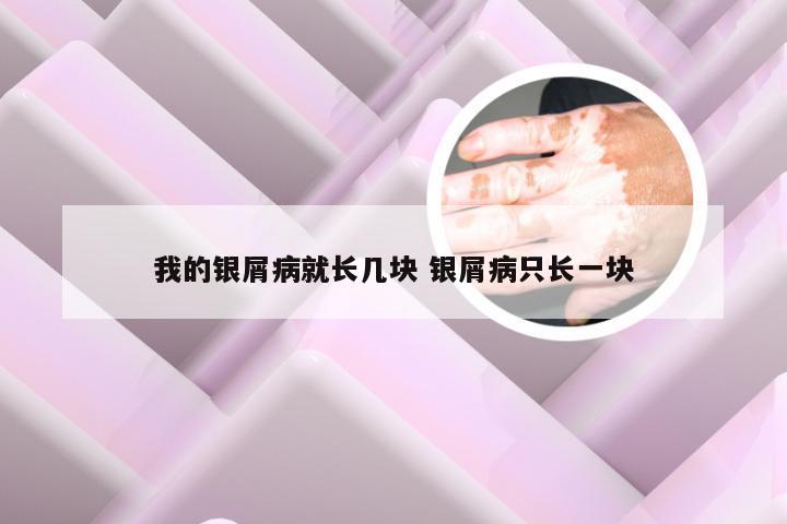 我的银屑病就长几块 银屑病只长一块