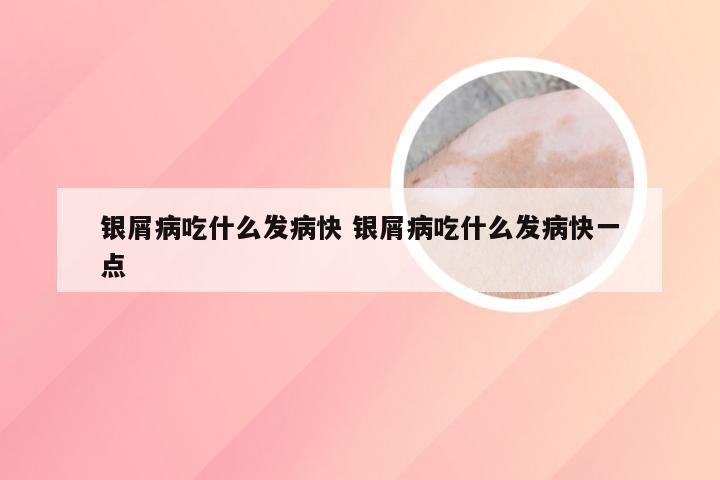 银屑病吃什么发病快 银屑病吃什么发病快一点