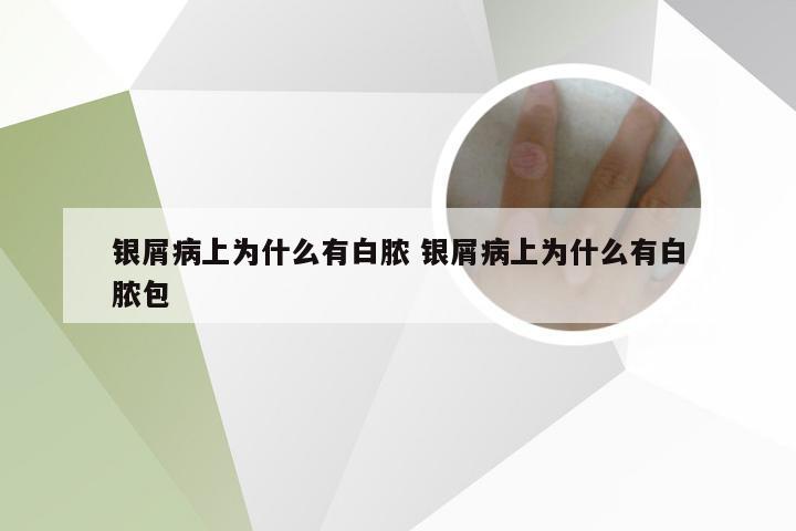 银屑病上为什么有白脓 银屑病上为什么有白脓包