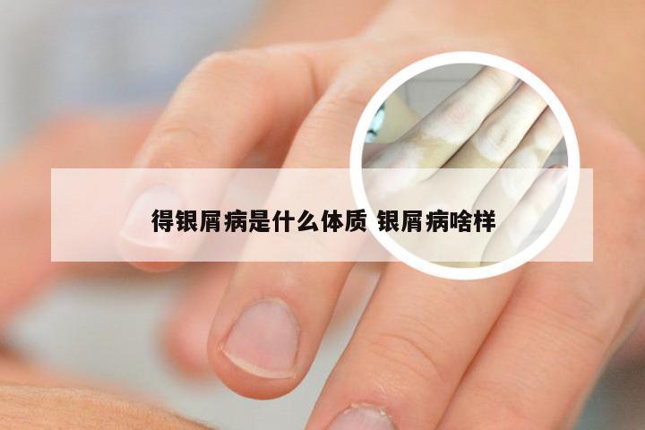 得银屑病是什么体质 银屑病啥样